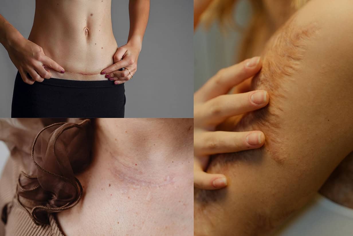 Blizny Niepozorne Źródło Komplikacji