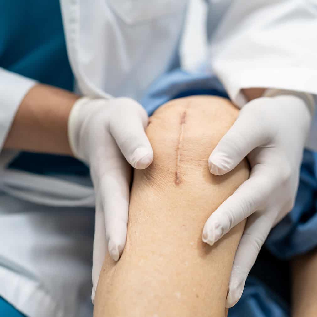 korzyści terapii blizn - fizjoterapeutka ogląda kolano z blizną