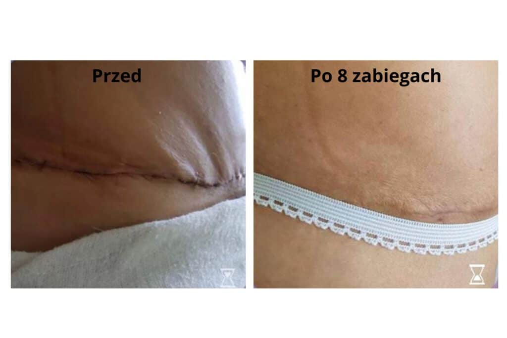 przykład terapii blizn za pomocą technologii marki INDIBA